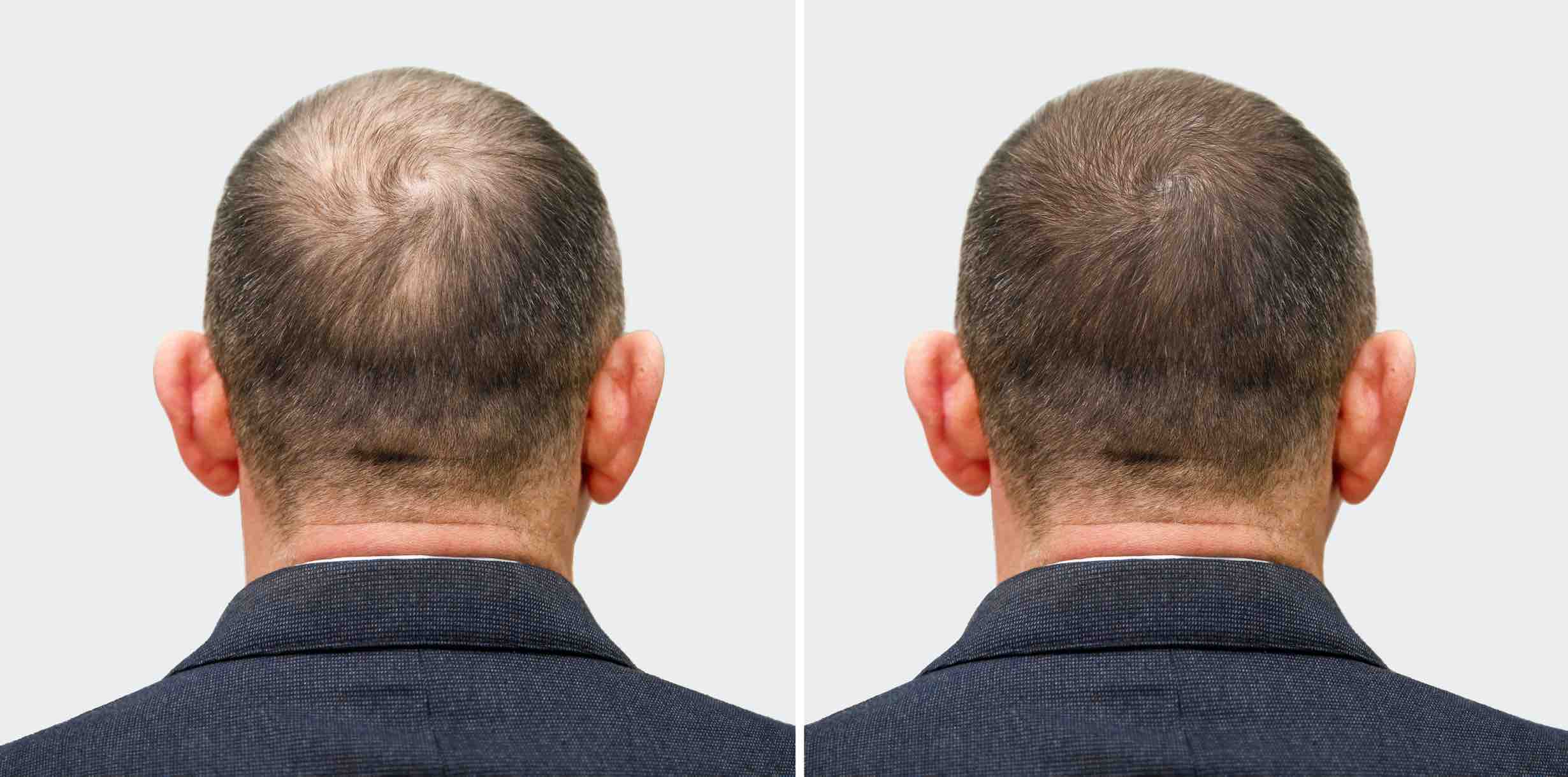 What do Eucalyptus Stem Cells Have to Do with Male Pattern Balding?