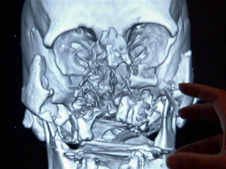 This is a CT scan of a Woman Who Was Attacked By a Chimp. A 1-0 New Zealand MMA Fighter is Supposedly Going to Fight One, Soon.